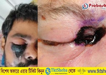 ব্ল্যাক ফাঙ্গাস নিয়ন্ত্রণে কঠোর সতর্কবস্থায় ওমান