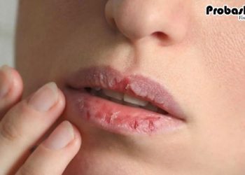 গরমেও ঠোঁট ফাটে ? জানুন এর প্রতিকার