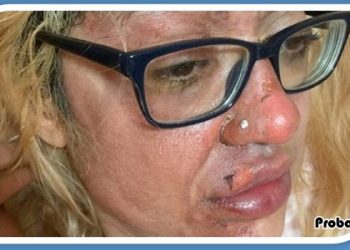 টিকটক দেখে ডিম সিদ্ধ করতে গিয়ে ঝলসে গেল মুখ