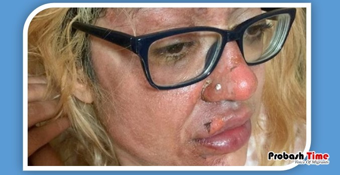 টিকটক দেখে ডিম সিদ্ধ করতে গিয়ে ঝলসে গেল মুখ