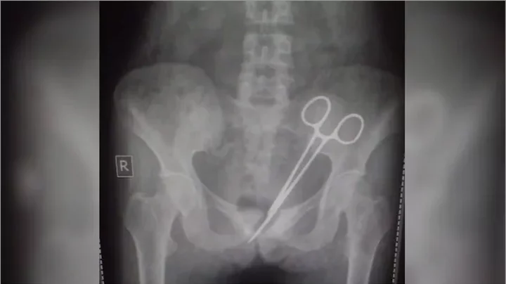 ডাক্তারের ভুলে পেটের ভেতর কাঁচি, বের করা হলো ১২ বছর পর
